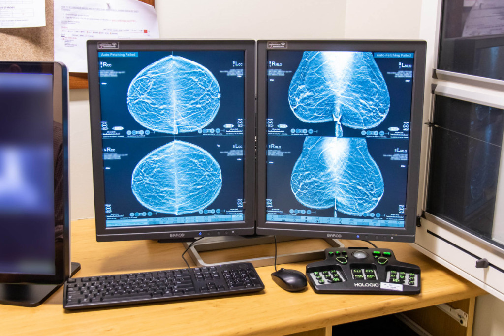 Mammography